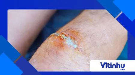 Por que a água-oxigenada faz espuma em ferimentos?